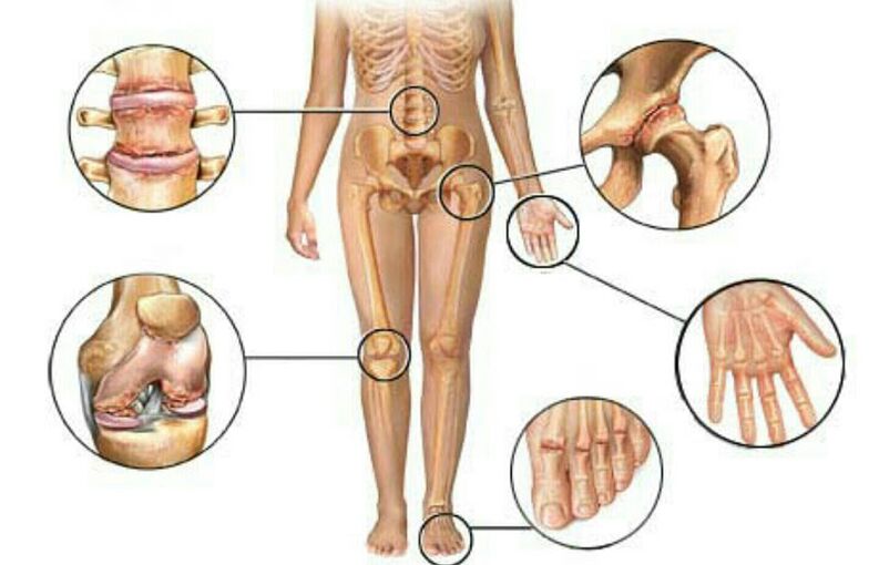 أنواع ودرجات التهاب المفاصل